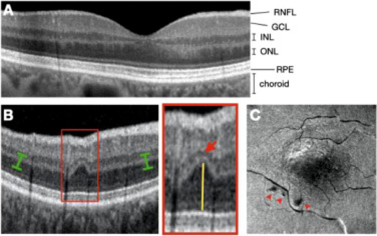 Na retina, os ollos atoparon unha enfermidade cardiovascular biomarker 16625_2