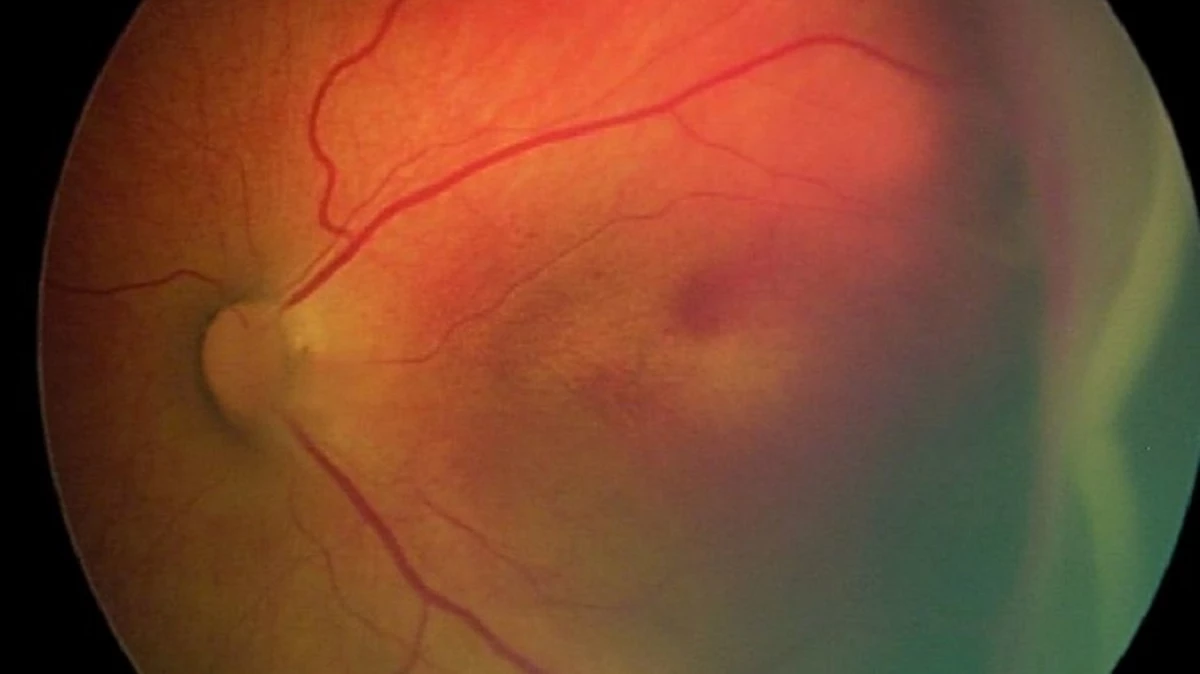 Noi boli cardiovasculare biomarker detectate în retină 8697_1
