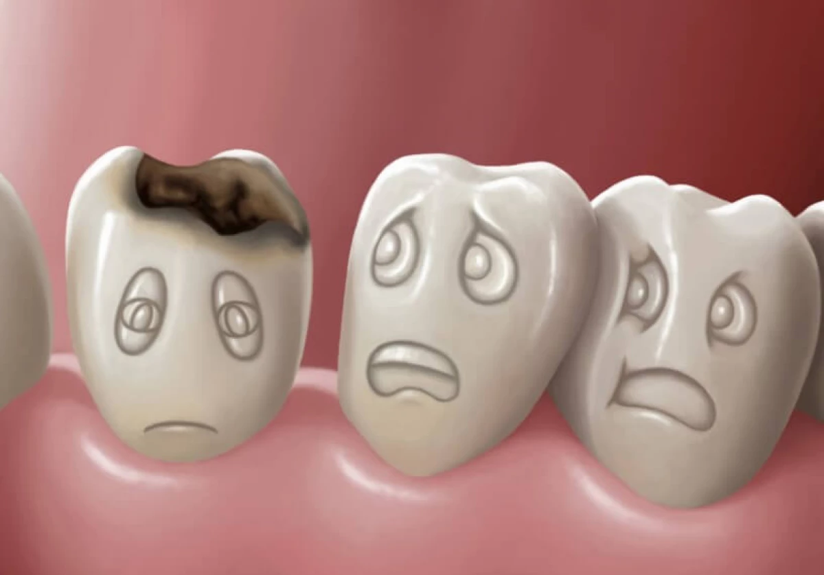Ինչն է առաջացնում կարիեսը եւ ինչպես պաշտպանել ձեր ատամները: 9953_2