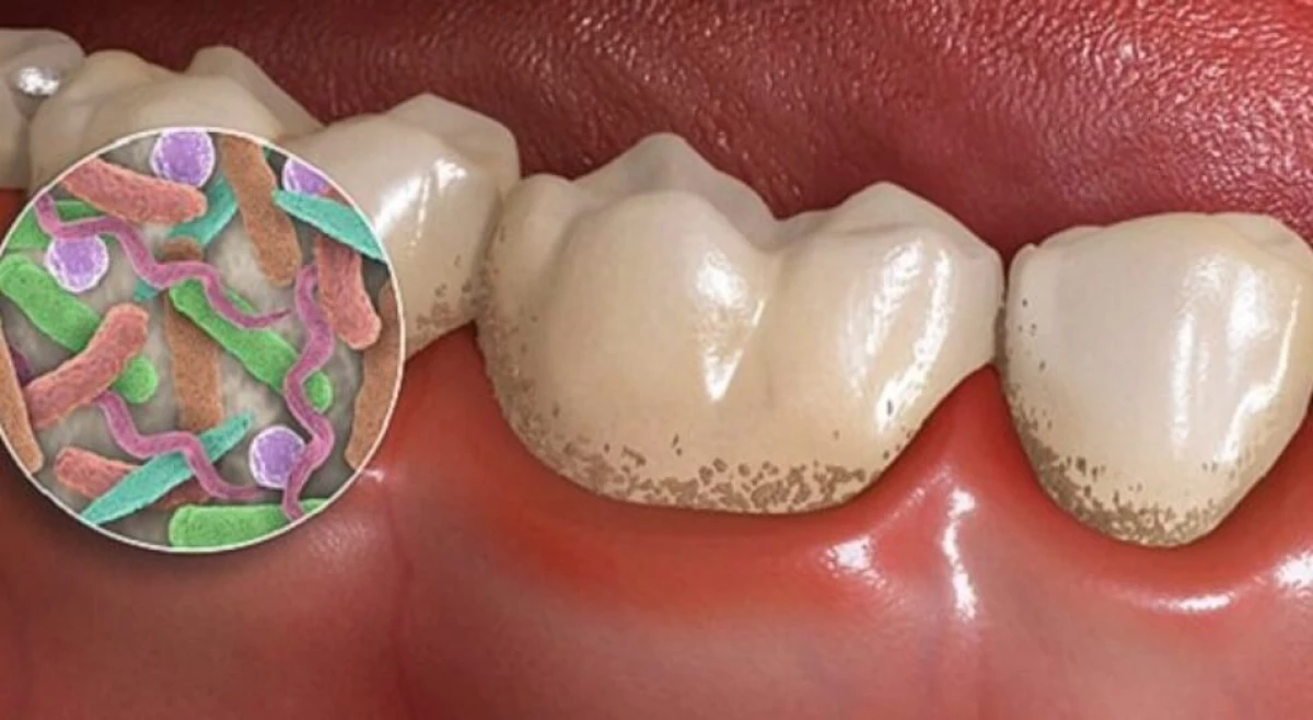 Kas sukelia ėduonį ir kaip apsaugoti dantis? 9953_5